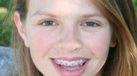 Braces